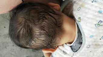婴幼儿头发稀疏是怎么回事