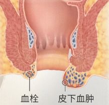 不同痔疮,该如何处理