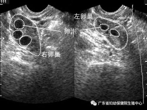 促排卵之监测卵泡 