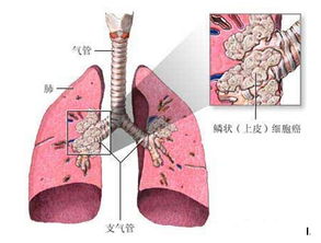 发现一个新的肺鳞癌治疗靶点