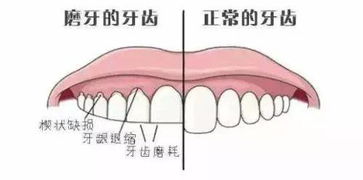 睡觉经常磨牙的人要小心,你正在慢慢变丑 