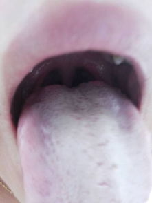 舌头前面有裂痕,中间红点大 舌根有凸起的红疹子 舌头发干发麻 舌尖有时候疼 每天清晨一睡醒就喉咙痛 