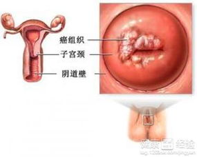 慢性盆腔炎会转化为宫颈癌吗