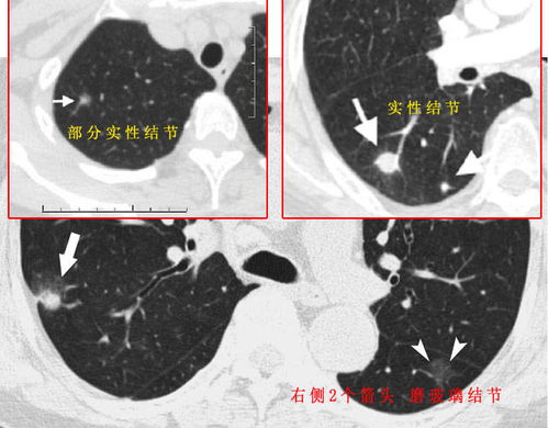 肺结节可以用中药治疗吗