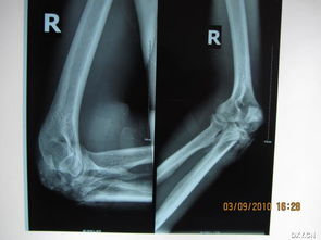 肘部骨折固定绑带图片 搜狗图片搜索