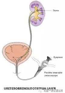 尿科说输尿管 软镜