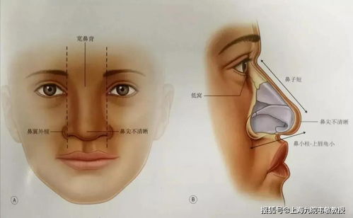 上海韦敏教授丨成功的鼻综合对于整体颜值有哪些影响