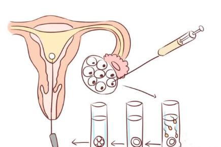 一怀不上就想着做试管 做试管前别稀里糊涂,得了解清楚这些