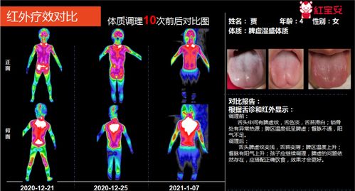 探索红外热成像在医学诊断中的应用