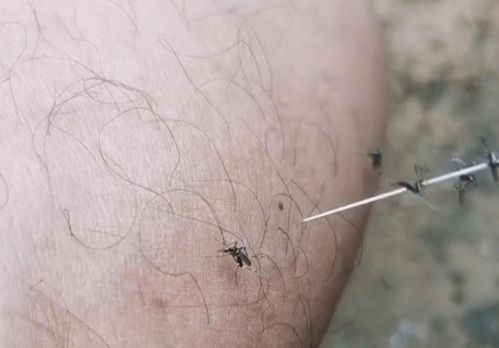 山东一男子被十多只蚊子咬急眼,拿起针对着腿上的蚊子猛刺戳成串
