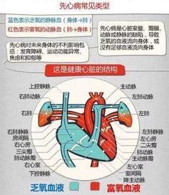 什么是先天性心脏病(什么是先天性心脏病心漏洞)