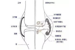 骨关节疾病