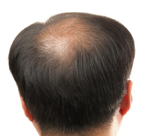 斑秃脱发，斑秃和脂溢性脱发的区别