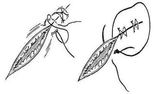 图文并茂 详解各种外科缝合方法