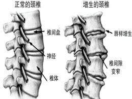 得了颈椎病怎么办 颈椎病类型 颈椎病图片 