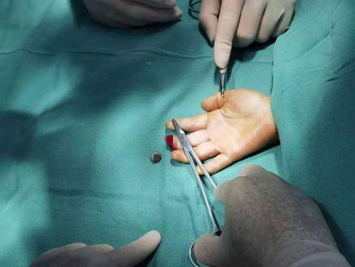 健强手足医院丨手指被切断如何处理 医师忠告 这四点极其关键