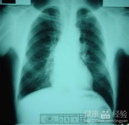 肺结核钙化 斗图表情包大全 - 与 肺结核钙化 相