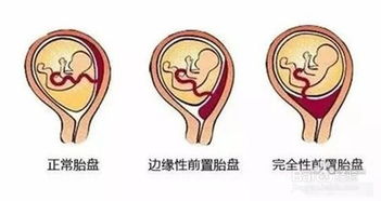 前置胎盘的产妇可以顺产吗 