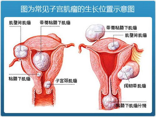 武汉仁爱医院专业妇科 子宫肌瘤会造成不孕吗 可不可以生孩子