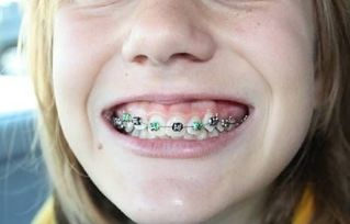 怎么预防儿童牙齿不齐 
