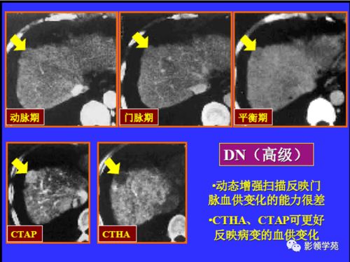 肝细胞腺瘤 HA 的影像学表现