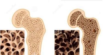 老人如何预防骨质疏松 汤臣倍健胶原软骨素钙片有方法 