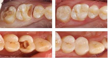瓷嵌体和传统树脂补牙方式有什么区别