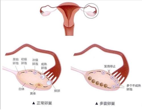 北京不孕不育医院 多囊卵巢能不能怀孕