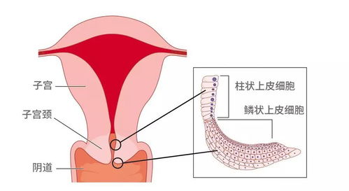 人流和公頸靡爛一起治後要流血多久?