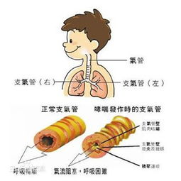 育儿专家崔玉涛解读 小儿过敏性咳嗽,有什么办法能缓解