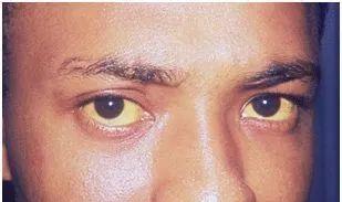 肝不好的人眼睛会出现哪些信号(肝不好的人 眼睛会发出4个信号)