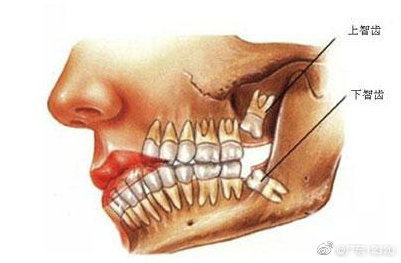 智齿,究竟是怎么回事