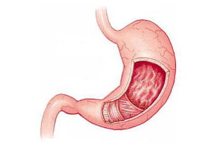 哪种方法治疗慢性浅表性胃炎好