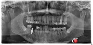 即刻种植病例一例 备洞 拔牙 植入 