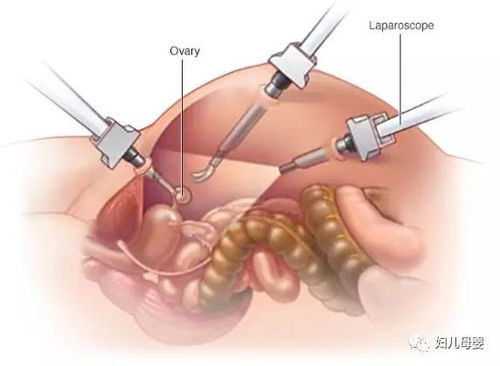 卵巢切除术 