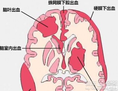 脑溢血后遗症的4种护理知识