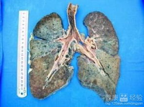 二期矽肺会引起哪些症状