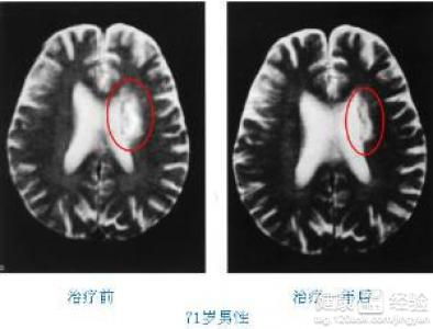 腔隙性脑梗塞能治好吗