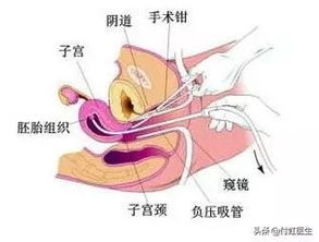 无痛人流后，月经怎么会比以前少呢？