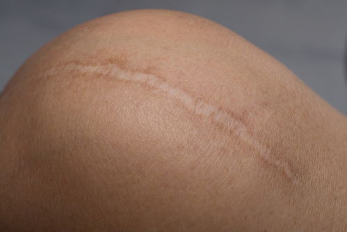 广州疑难皮肤病研究院 疤痕凸起就是疤痕增生了吗
