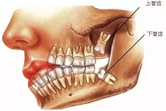 智齿不疼就不用拔 医生这样说