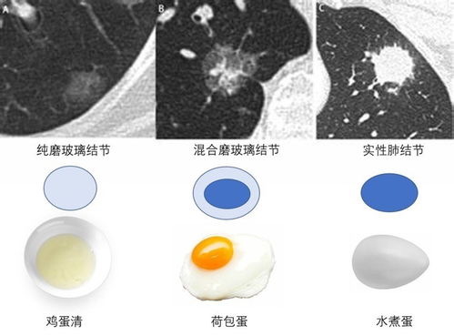 体检发现肺结节怎么办 胸外科专家这样建议