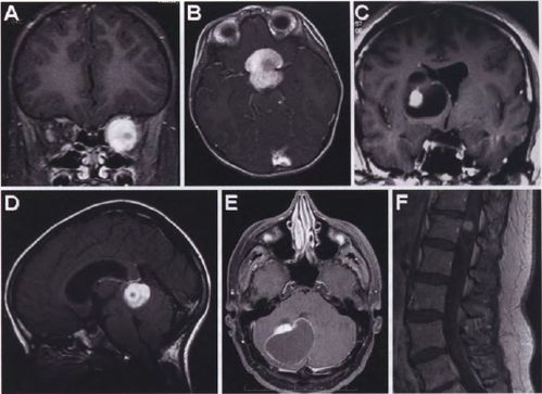 毛细胞型星形细胞瘤的临床病理学特征