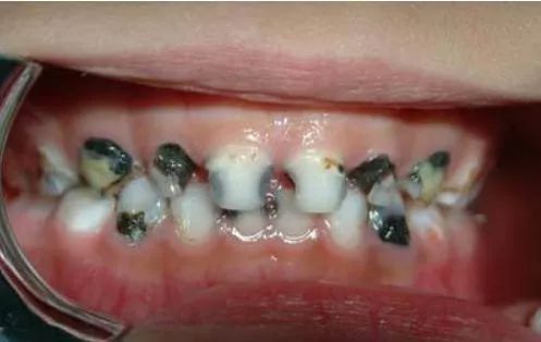 育儿丨出牙晚 怕蛀牙 影响孩子一辈子的乳牙问题得重视
