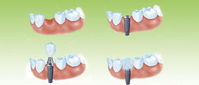 请问修复种植牙注意什么呢？