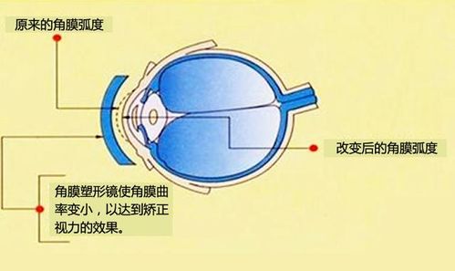 角膜塑形镜 RGP 近视手术的区别