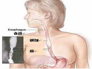 我爸检查出食道癌，食道癌这个病真的就看不好吗(爸爸食道癌经验分享)