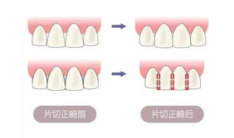 牙齿矫正 牙齿片切是什么 为什么要做片切