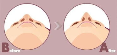 注射隆鼻和假体隆鼻有什么区别 