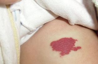 婴儿屁股上青斑竟成血管瘤 宝宝身上胎记哪些有害 